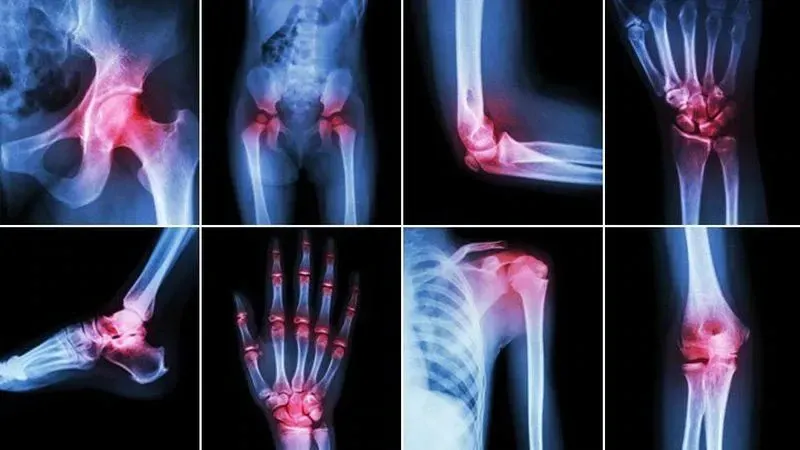 Osteoarthritis